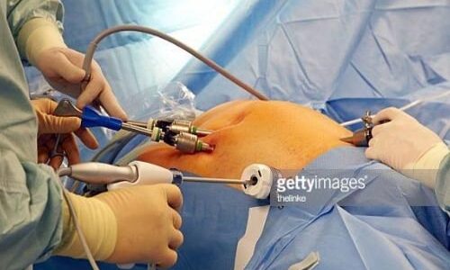 laparoscopic-surgerygy-service-1